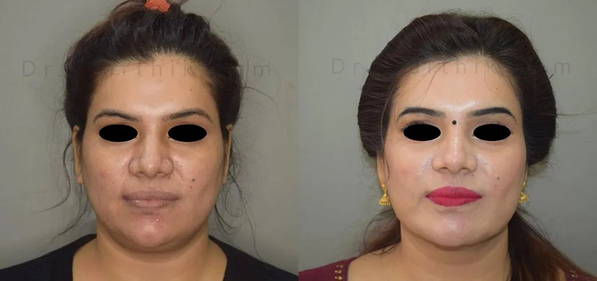double chin liposuction before and after photo by chennai plastic surgery in india