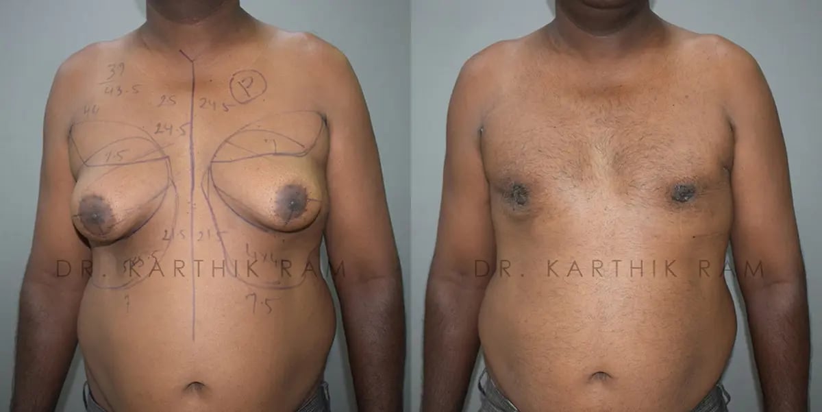 gynecomastia before and after photo by chennai plastic surgery in india