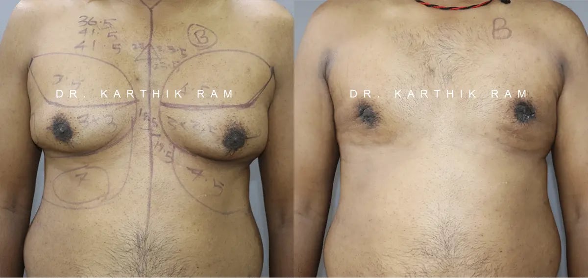 gynecomastia before and after photo by chennai plastic surgery in india