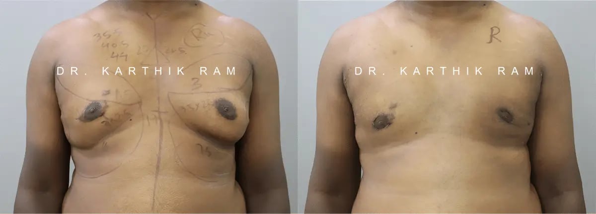 gynecomastia before and after photo by chennai plastic surgery in india