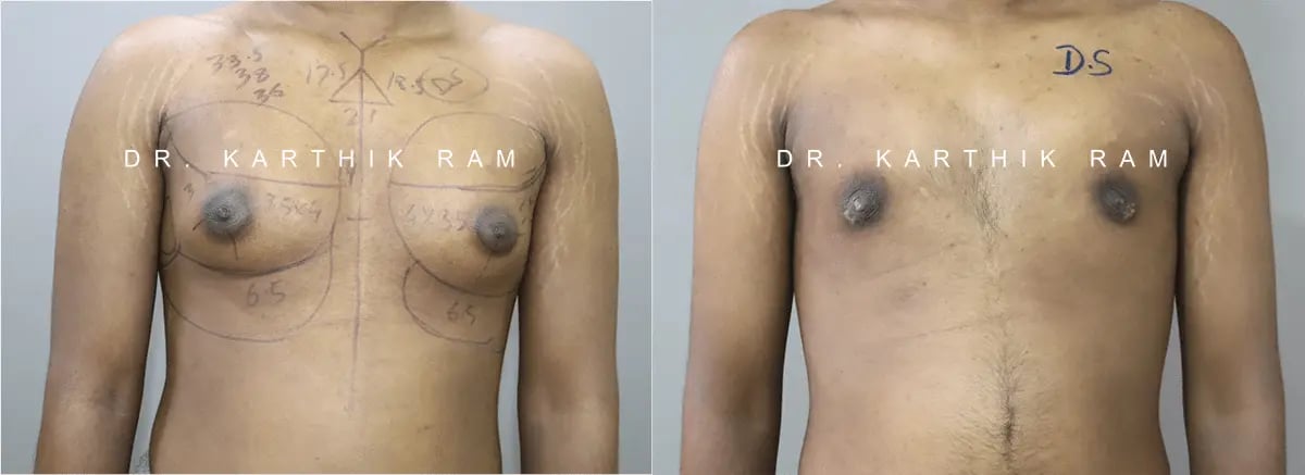 gynecomastia before and after photo by chennai plastic surgery in india