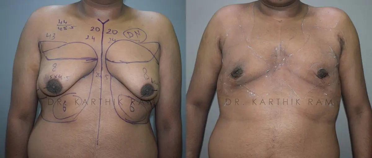 gynecomastia before and after photo by chennai plastic surgery in india