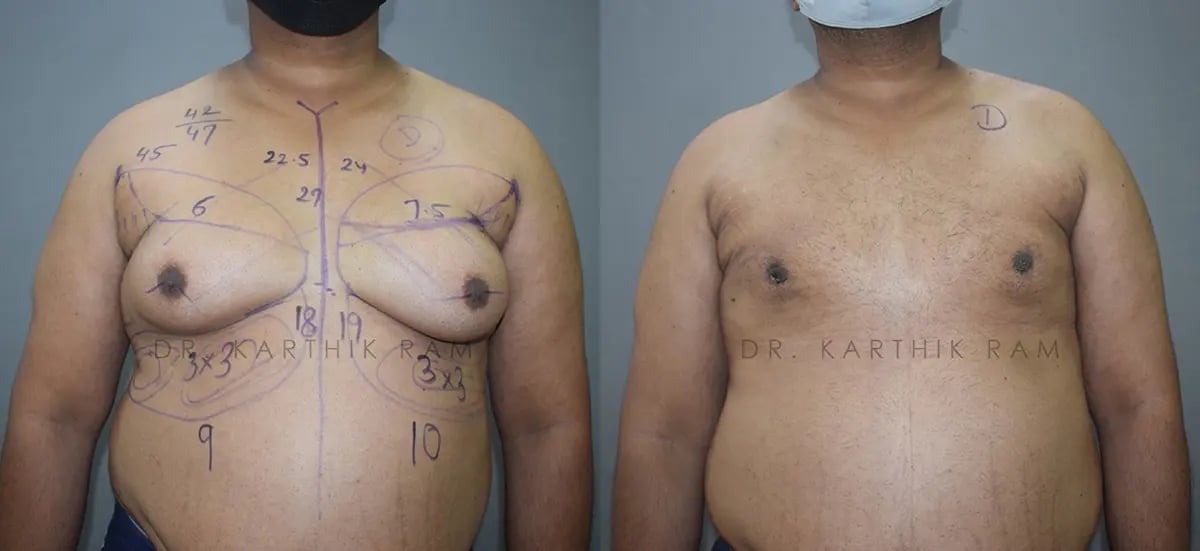 gynecomastia before and after photo by chennai plastic surgery in india