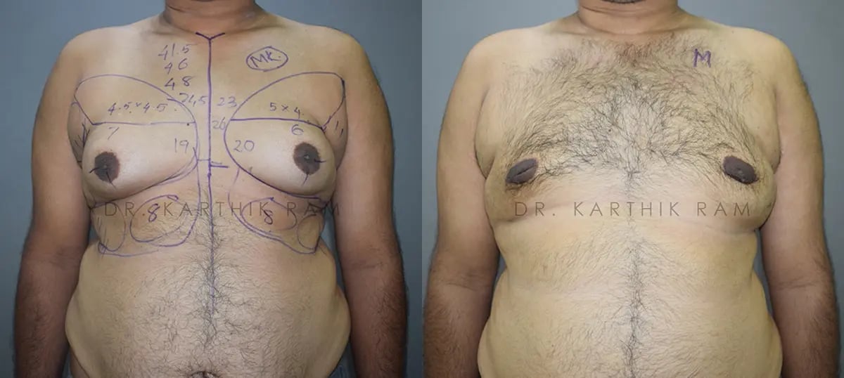 gynecomastia before and after photo by chennai plastic surgery in india