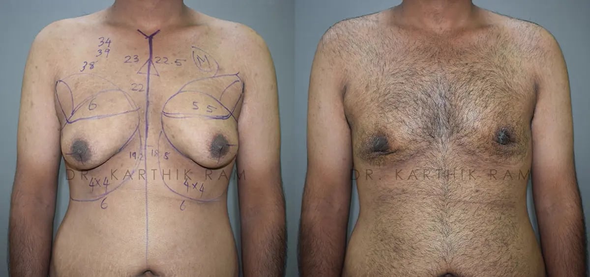 gynecomastia before and after photo by chennai plastic surgery in india