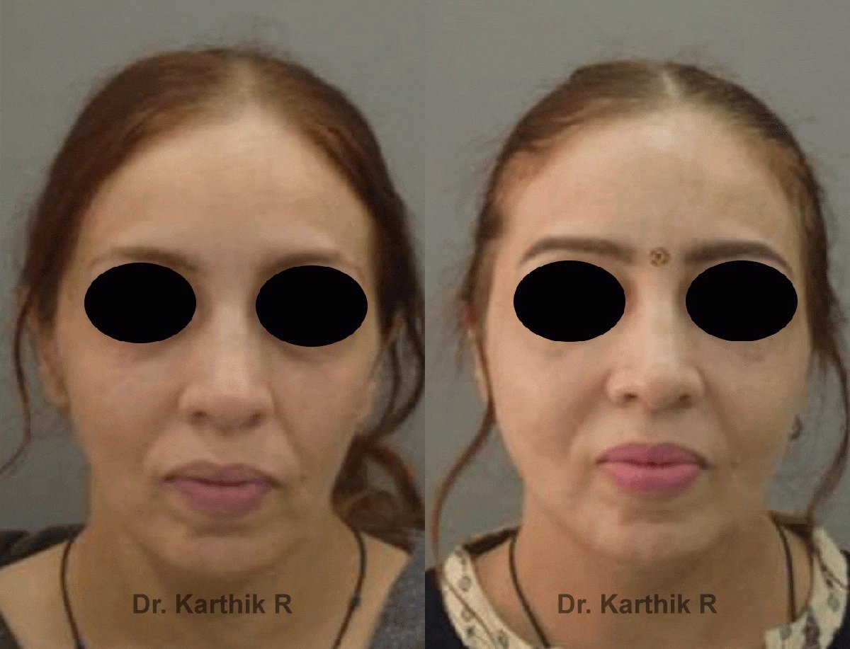 fat graft fat fill fat transfer before and after photo by chennai plastic surgery in india