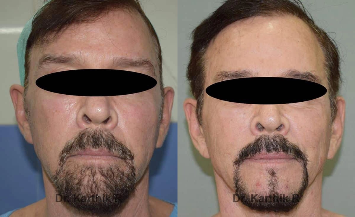 fat graft fat fill fat transfer before and after photo by chennai plastic surgery in india