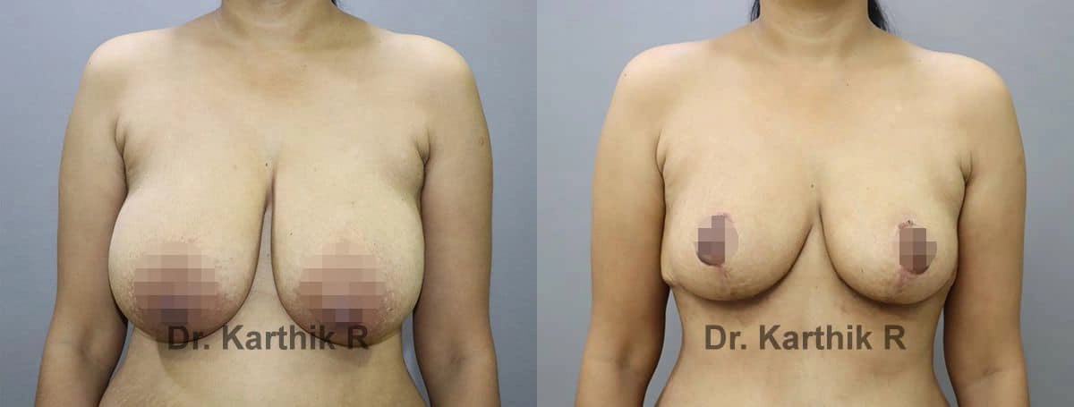 breast reduction breast lift before and after photo by chennai plastic surgery in india