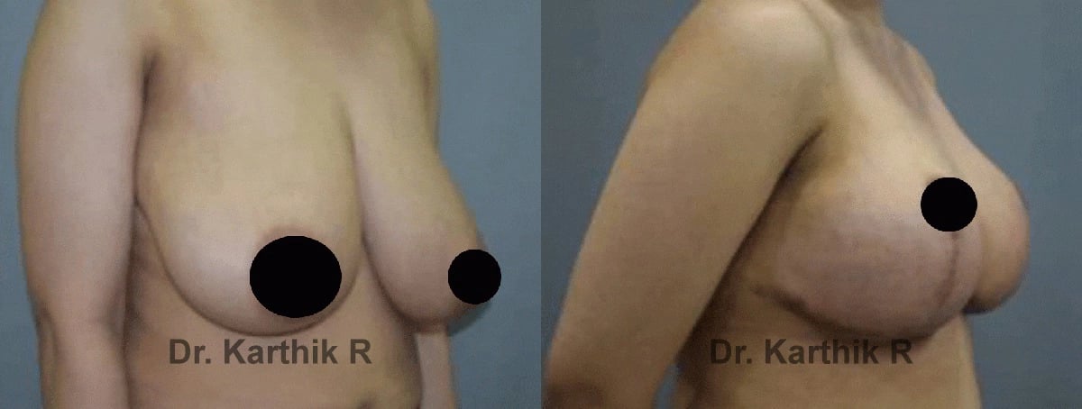 breast reduction breast lift before and after photo by chennai plastic surgery in india