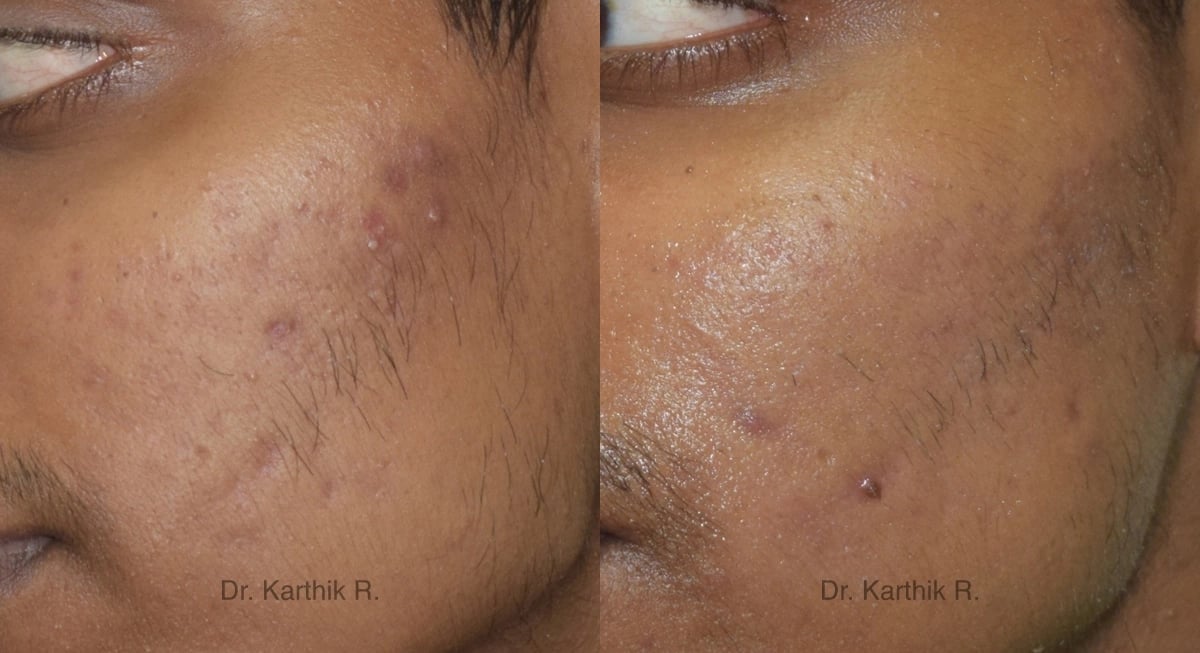 chemical peels microdermabrasion before and after photo by chennai plastic surgery in india