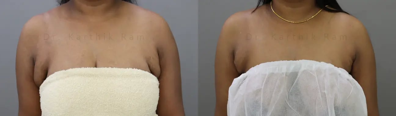 axillary tail of breast before and after photo by chennai plastic surgery in india
