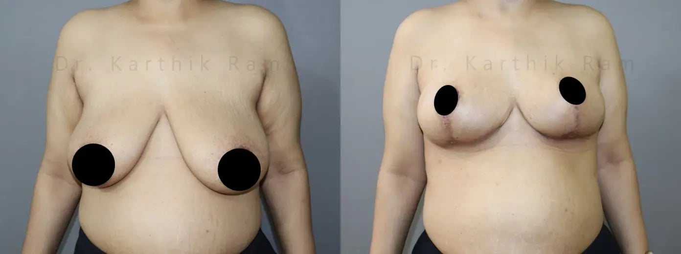 breast reduction before and after photo by chennai plastic surgery in india