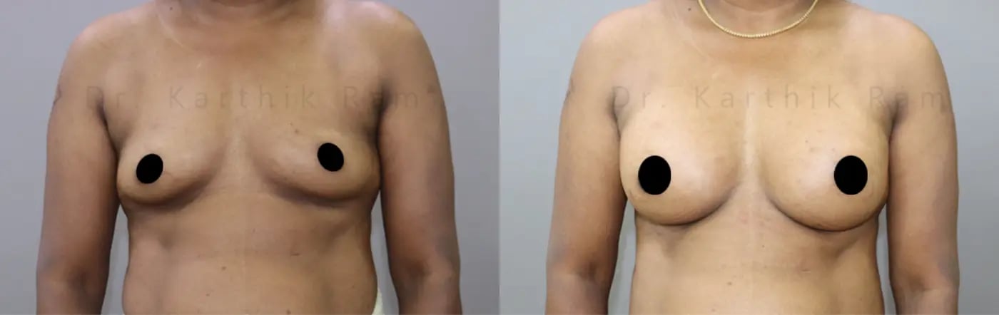 breast implants before and after photo by chennai plastic surgery in india