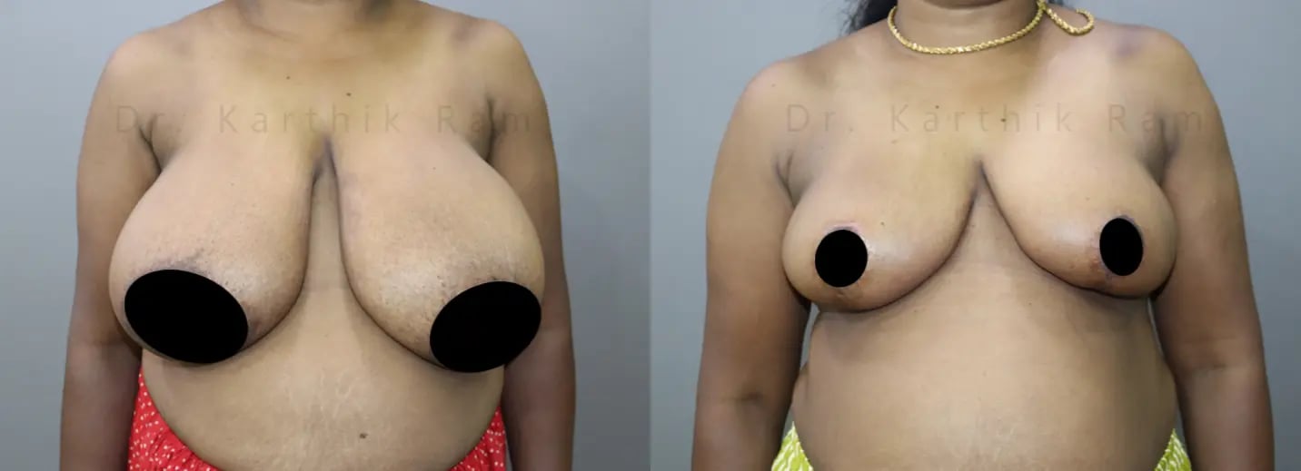 breast reduction before and after photo by chennai plastic surgery in india