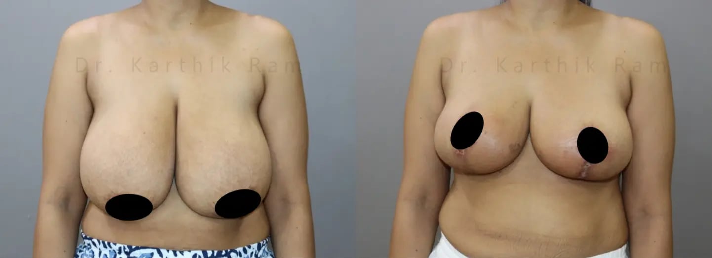 breast reduction before and after photo by chennai plastic surgery in india