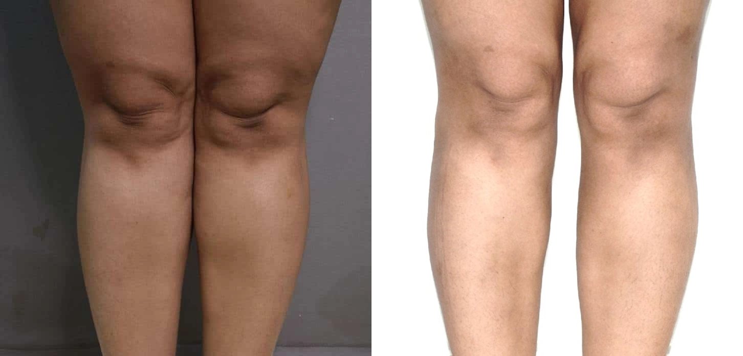 vaser liposuction before and after photo by chennai plastic surgery in india