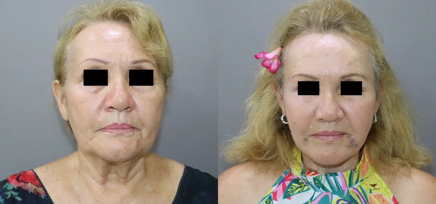 facelift before and after photo by chennai plastic surgery in india