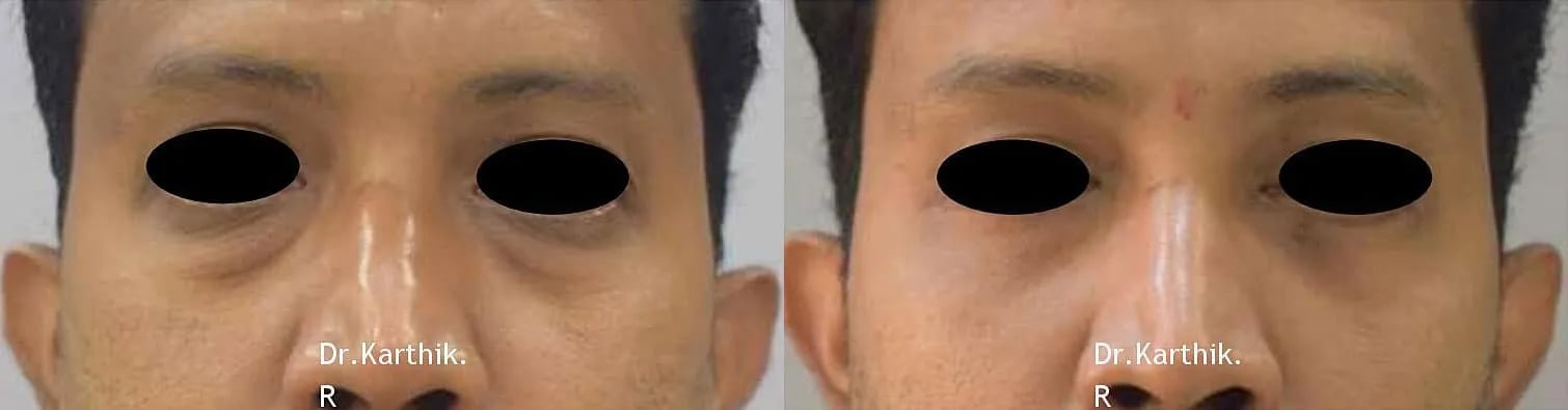blepharoplasty before and after photo by chennai plastic surgery in india