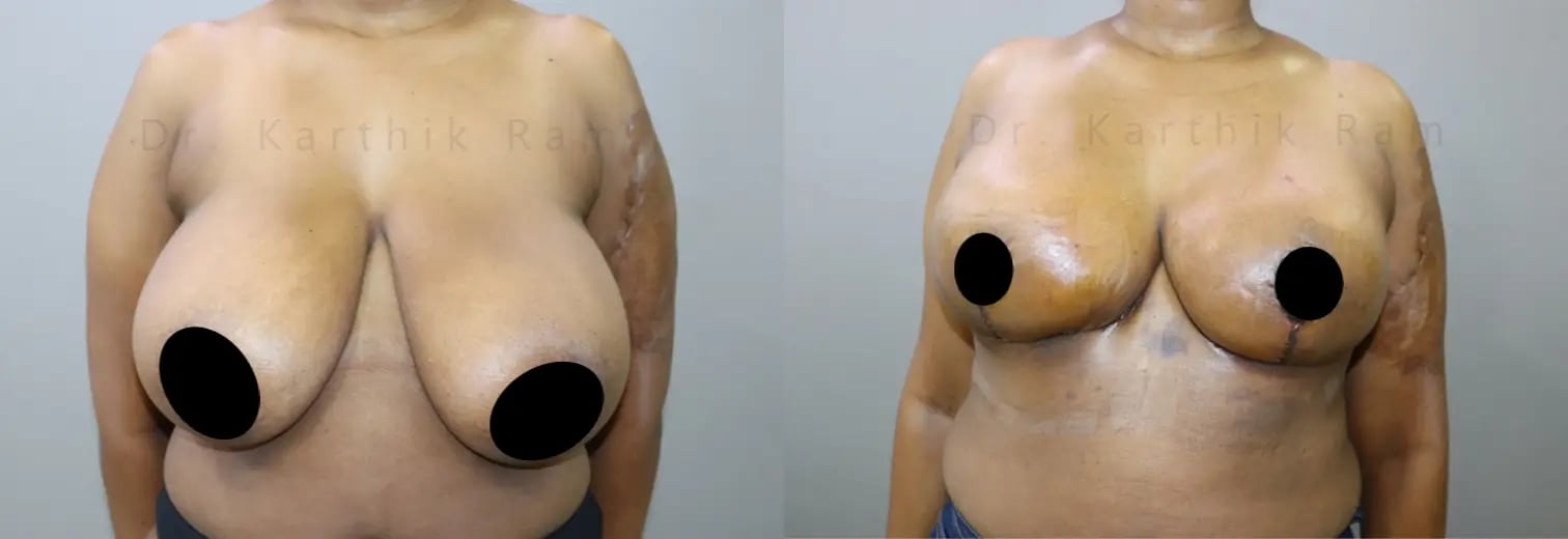 breast reduction before and after photo by chennai plastic surgery in india