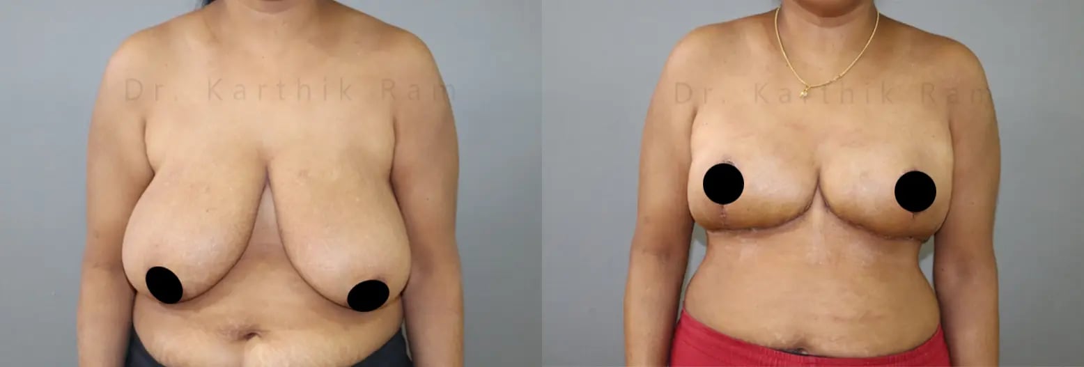 breast reduction before and after photo by chennai plastic surgery in india