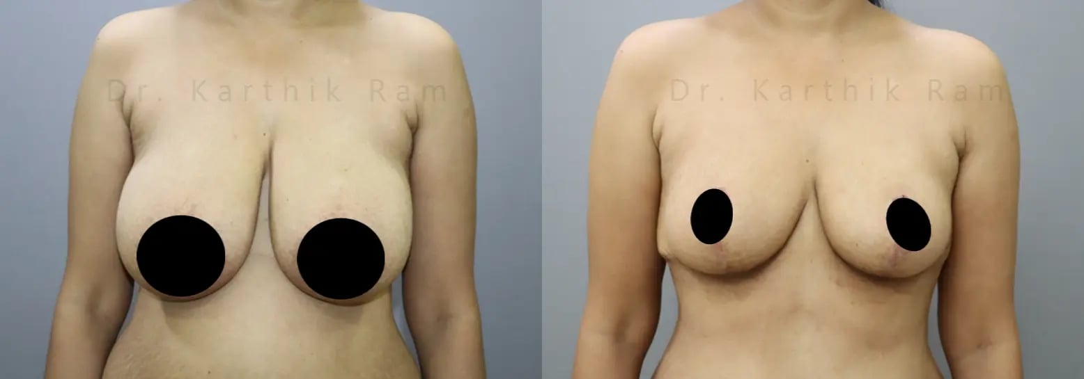 breast reduction before and after photo by chennai plastic surgery in india