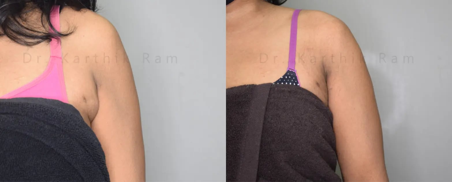 axillary tail of breast before and after photo by chennai plastic surgery in india