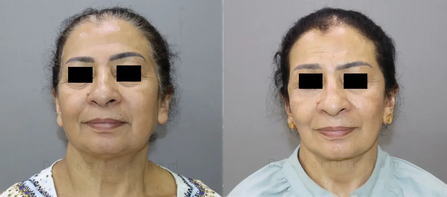 facelift before and after photo by chennai plastic surgery in india