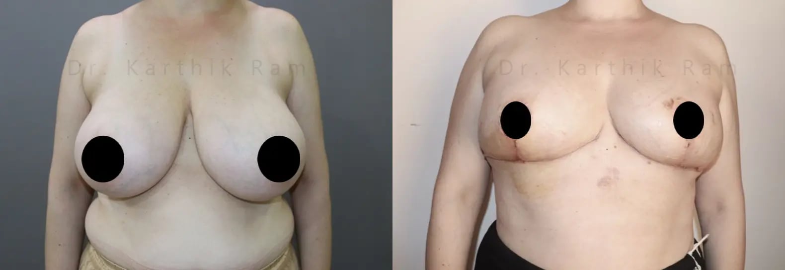 breast reduction before and after photo by chennai plastic surgery in india