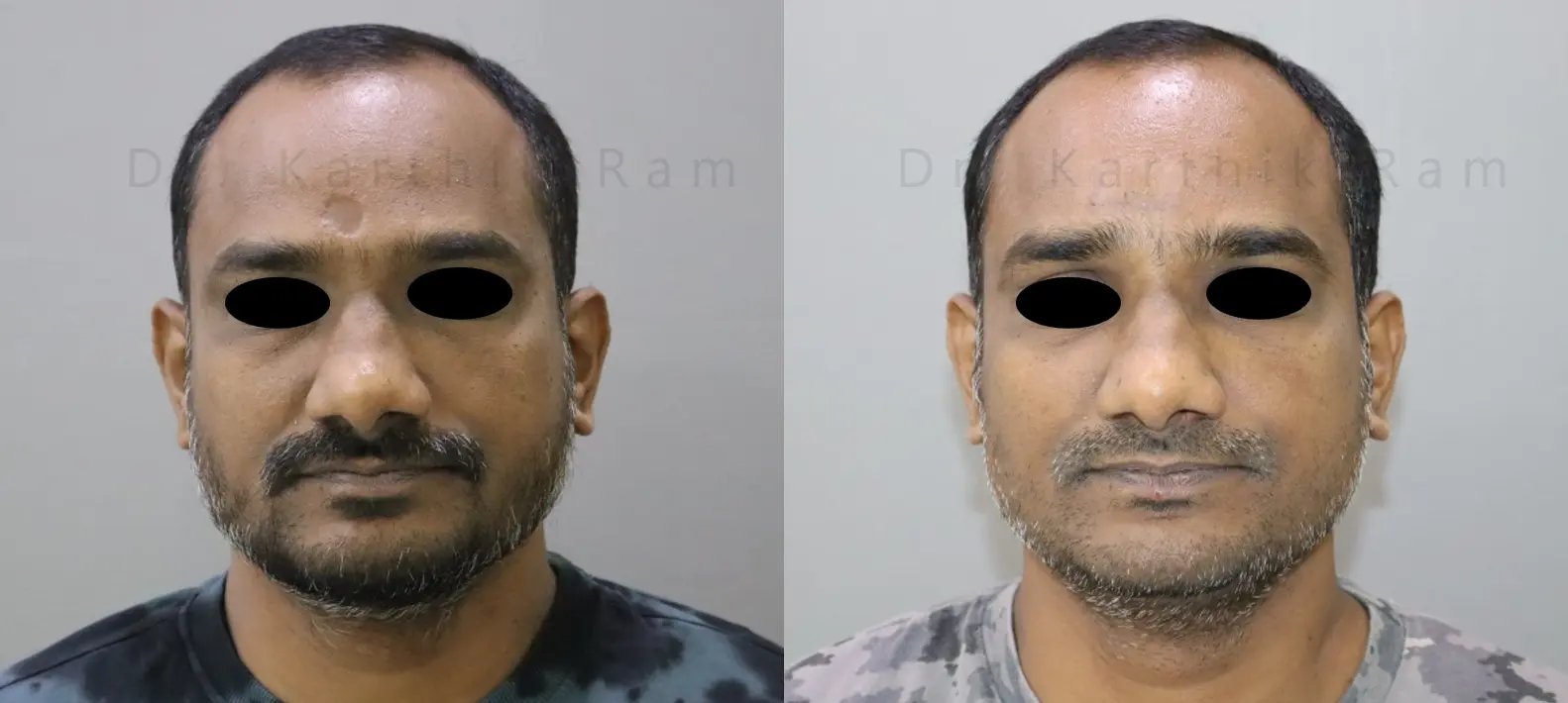scar revision before and after photo by chennai plastic surgery in india