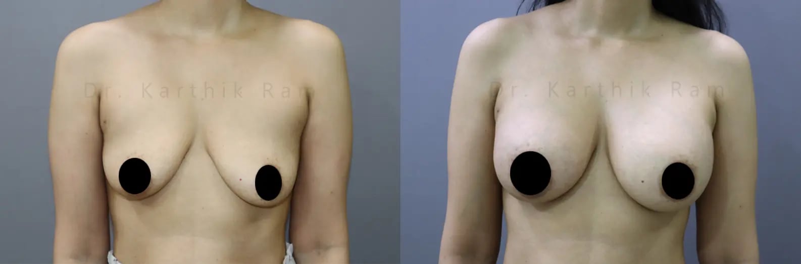 breast implants before and after photo by chennai plastic surgery in india