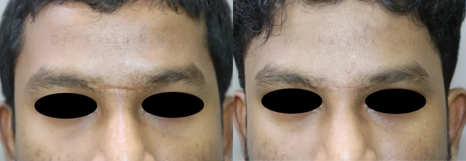 scar revision before and after photo by chennai plastic surgery in india