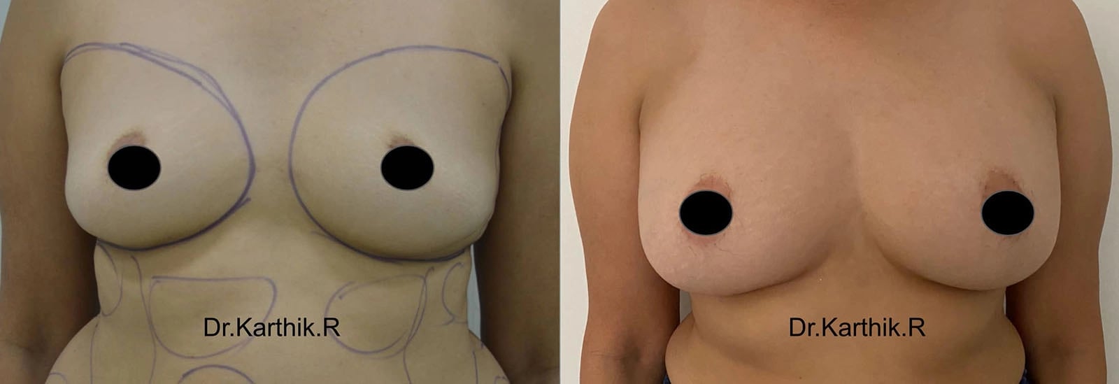 breast fat fill before and after photo by chennai plastic surgery in india