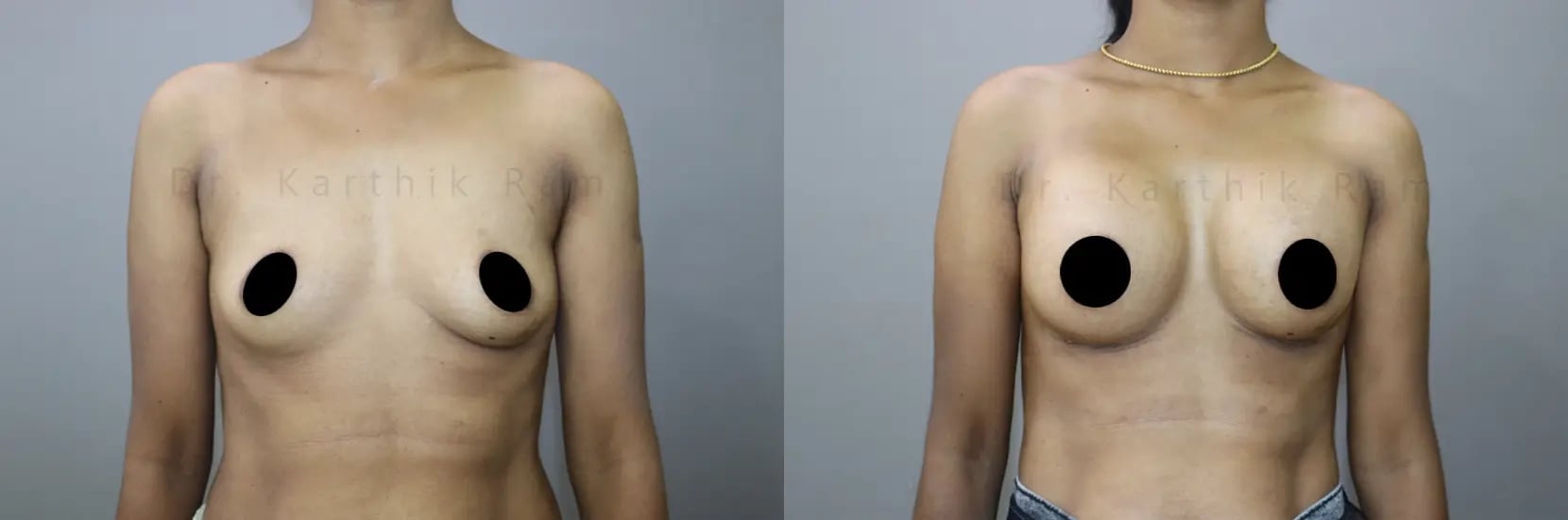 breast implants before and after photo by chennai plastic surgery in india