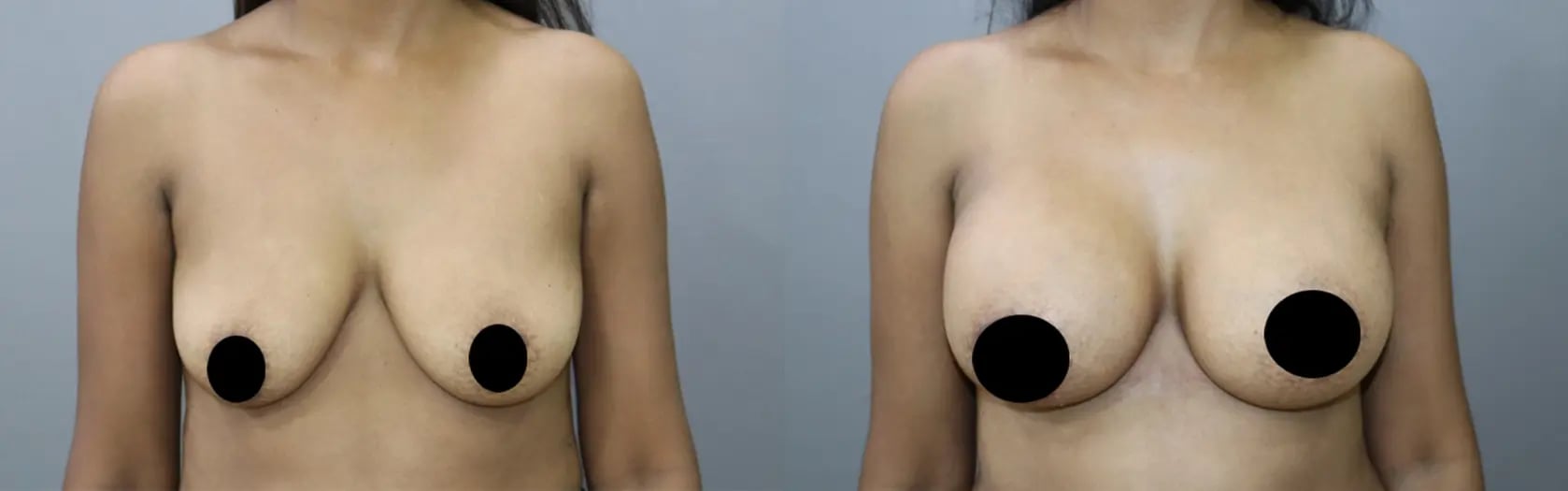 breast implants before and after photo by chennai plastic surgery in india