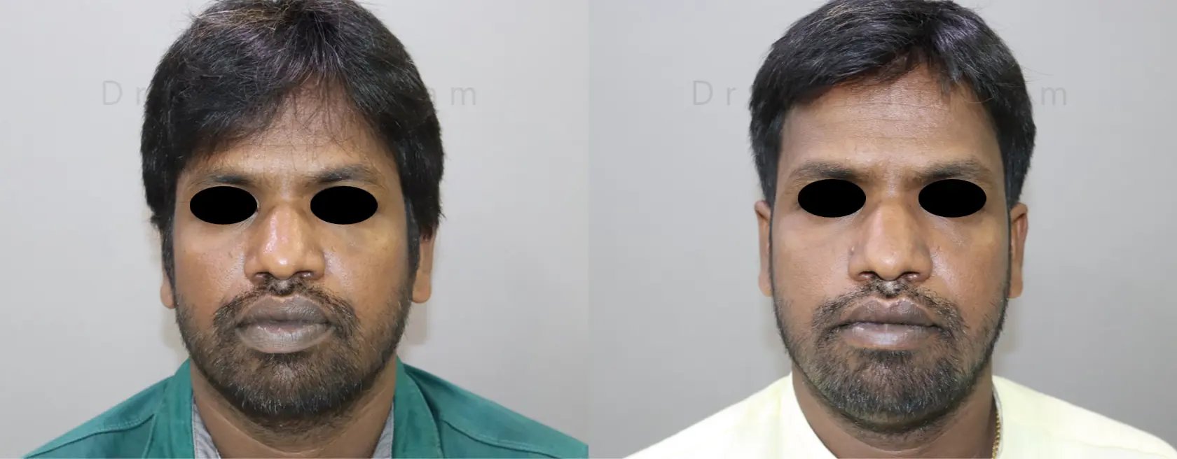 lip correction before and after photo by chennai plastic surgery in india