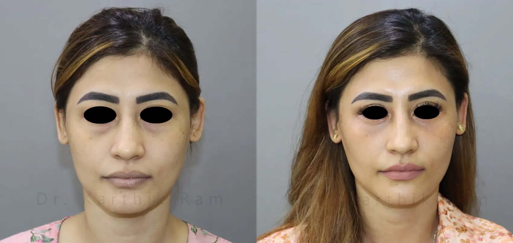 blepharoplasty thigh lift before and after photo by chennai plastic surgery in india