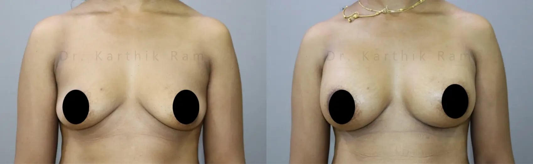 breast implants before and after photo by chennai plastic surgery in india