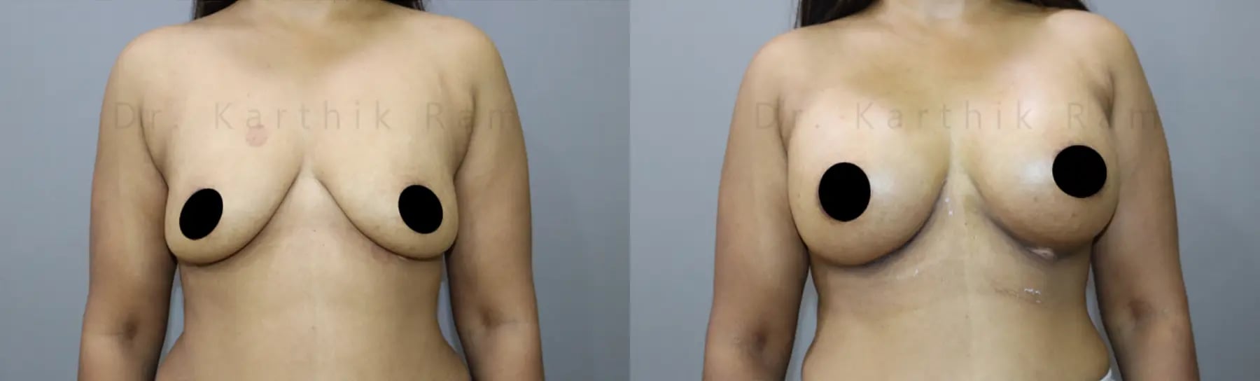 breast implants before and after photo by chennai plastic surgery in india