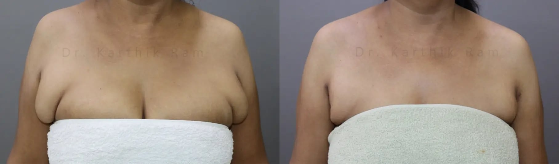 axillary tail of breast before and after photo by chennai plastic surgery in india