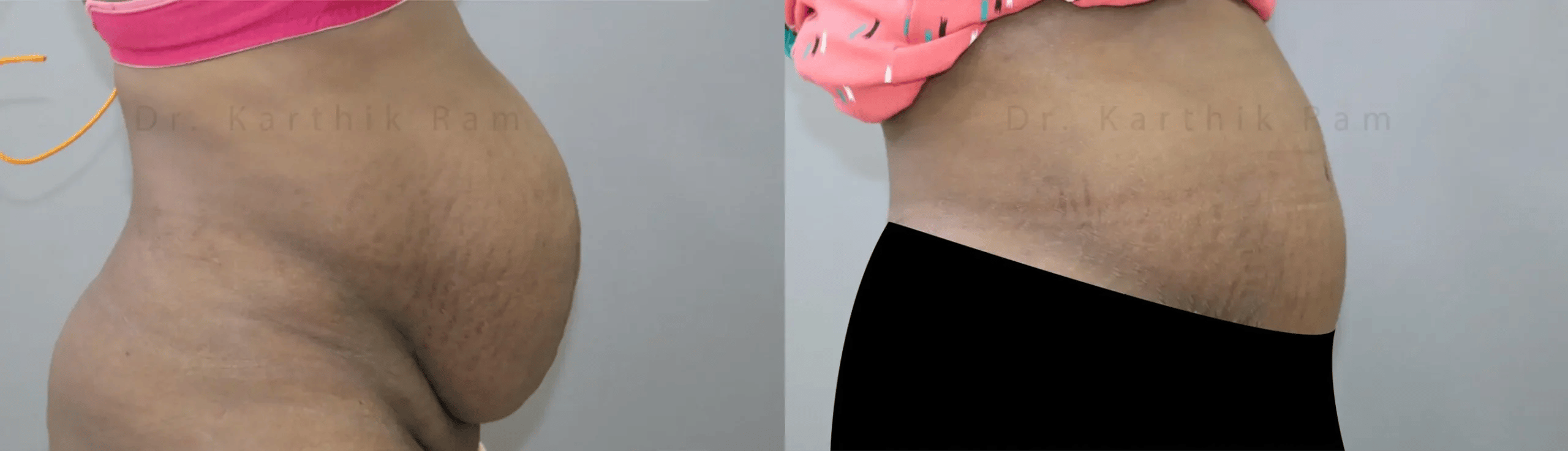 tummy tuck before and after photo by chennai plastic surgery in india