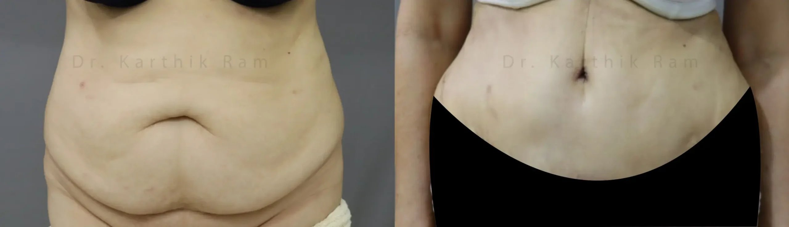 tummy tuck before and after photo by chennai plastic surgery in india