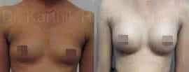 breast implants before and after photo by chennai plastic surgery in india