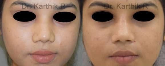 dermal fillers before and after photo by chennai plastic surgery in india