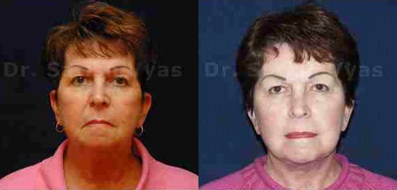 lip correction before and after photo by chennai plastic surgery in india