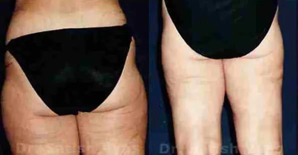 liposuction thighs before and after photo by chennai plastic surgery in india