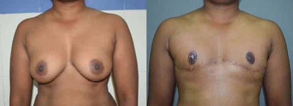 gender reassignment before and after photo by chennai plastic surgery in india