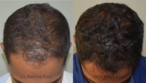 dermaroller scalp before and after photo by chennai plastic surgery in india
