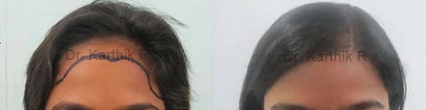 female hairline advancement before and after photo by chennai plastic surgery in india