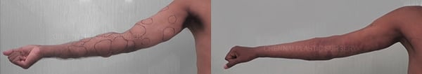multiple lipoma before and after photo by chennai plastic surgery in india