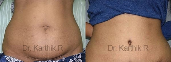 tummy tuck before and after photo by chennai plastic surgery in india